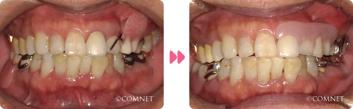 口腔内：奥歯の欠損術前ノンクラスプデンチャー
